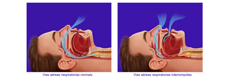Voc Sabe O Que Apn Ia Obstrutiva Do Sono